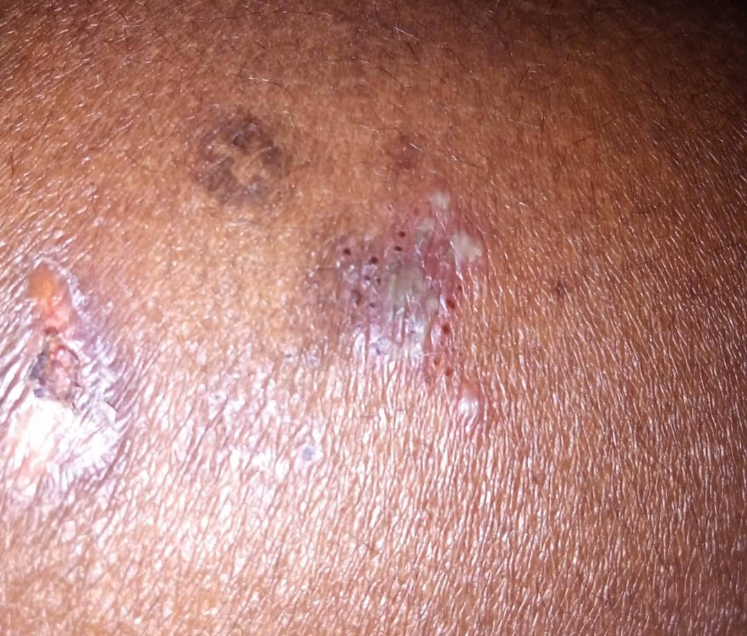 Infection