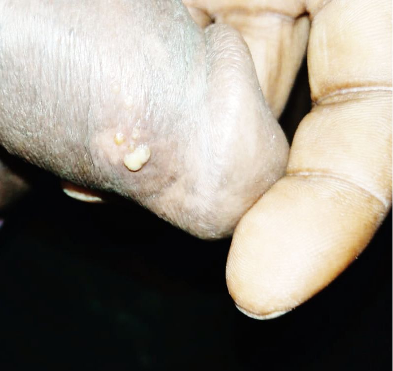 Penile Boil and Discharge