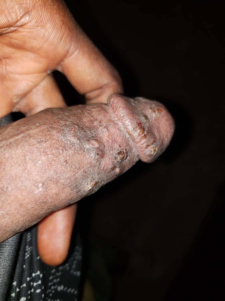 Penile Rashes