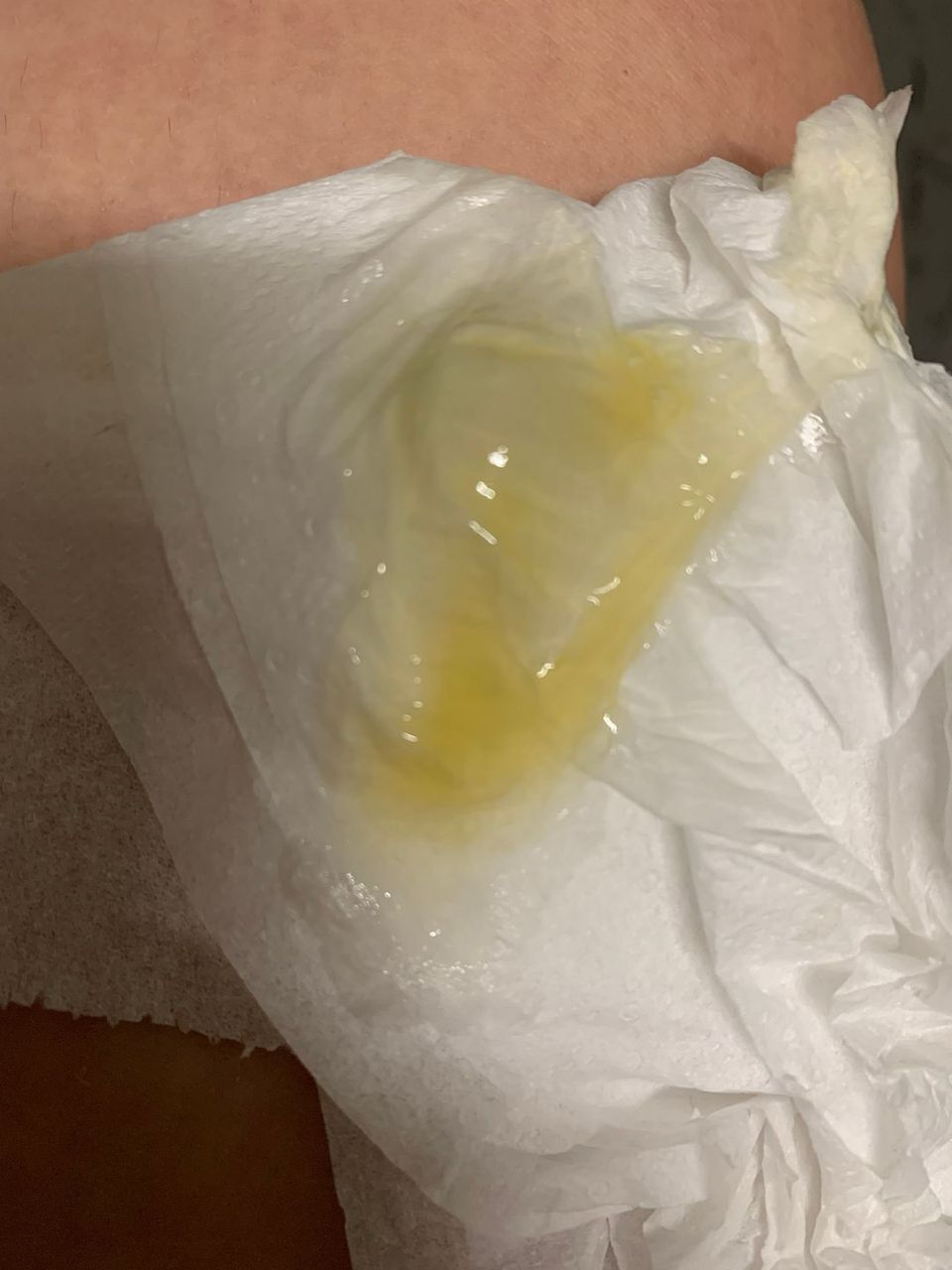 Yellow Sticky Discharge
